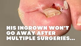 His INGROWN wont GO AWAY after MULTIPLE SURGERIES [upl. by Kennith]