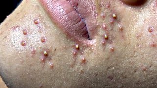 Big Cystic Acne Blackheads Extraction Blackheads amp Milia Whiteheads Removal Pimple Popping  3593 [upl. by Derman]