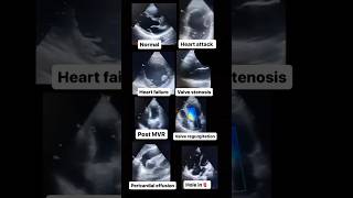 Echocardiogram NORMAL vs ABNORMAL radiology cardiology [upl. by Mcmaster]