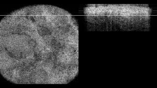 Optical Coherence Tomography Raster of Basal Cell Carcinoma [upl. by Keeler]