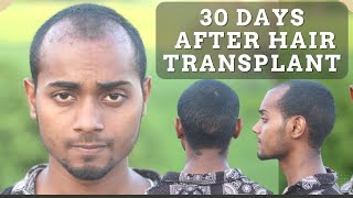 Shedding Phase  1 Month Condition After Hair Transplant  Hair Transplant Journey  Krishna Yadav [upl. by Whiteley]