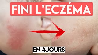 ECZÉMA  LA SOLUTION NATURELLE amp PAS CHÈRE 🙌 [upl. by Llyrat]