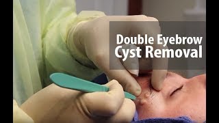 Double Eyebrow Cyst [upl. by Lilaj653]