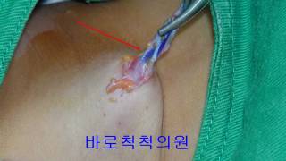 새열낭 branchial cleft cyst 鰓裂囊  전이개낭종preauricular sinus 수술하기 [upl. by Inerney598]