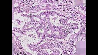 Histopathology Lung Adenocarcinoma [upl. by Aphra]