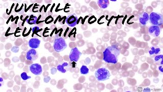 Juvenile Myelomonocytic Leukemia JMML Peripheral Blood Smear 2 year old Hematology amp Hemepath [upl. by Llerut]