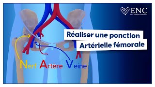 Comment ponctionner lartère fémorale [upl. by Selima]