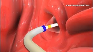 Balloon Eustachian Tube Dilation to Treat Eustachian Tube Dysfunction [upl. by Cartie157]