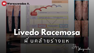 Livedo racemosa ผื่นคล้ายร่างแห  Sep 2023 [upl. by Sachsse499]