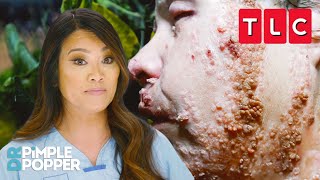 Strangest Skin Conditions  Dr Pimple Popper  TLC [upl. by Charbonneau]