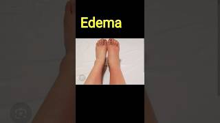 What is Edema swelling Edema pain [upl. by Ayerdna]