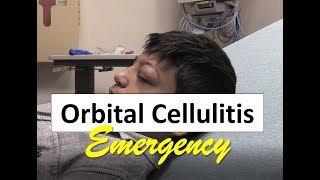 Orbital Cellulitis Emergency in a Child [upl. by Ybok953]