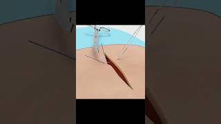 Sutures and Suturing techniques surgeryshortsanatomy [upl. by Sudhir829]