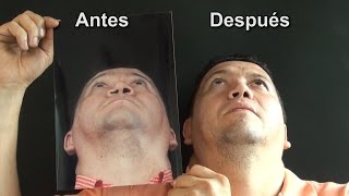 Reconstrucción con Rinoplastia Secundaria e implantes Paranasales Antes y Después Medellin Colombia [upl. by Jamesy]