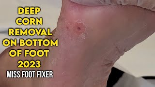 Treatment of Deep Foot Corn 2023  Corn Removal on Bottom of Foot By podiatrist Miss Foot Fixer [upl. by Ahseit]