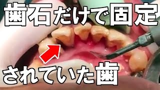 歯石除去治療 a tooth fixed with heavy tartar 【 dentistry】  cleaning歯石除去Vol1去牙石治療 [upl. by Wilburn]