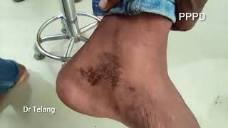 Progressive pigmented purpuric dermatosis  PPPD  capillaritis  drtelang [upl. by Nuhsed]