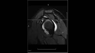 Shoulder Arthrography  Sublabral Foramen and Buford Complex [upl. by Treblah91]