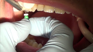 root canal treatment part 1 [upl. by Inglebert790]