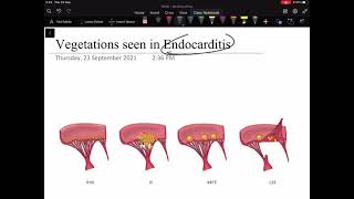 Vegetations seen in Rheumatic heart disease Libmannsack endocarditis and Infective Endocarditis [upl. by Wright]