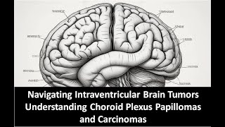 Navigating Intraventricular Brain Tumors Understanding Choroid Plexus Papillomas and Carcinomas [upl. by Liahcim]