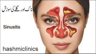 Sinusitis  Nasopharyngitis  hashmiclinics  homeopathic treatment [upl. by Goto]