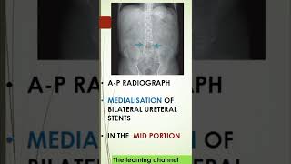 Spotter prepladder radiology radiologyresident neetpg neetpreparation marrow shortvideo [upl. by Ahtivak]