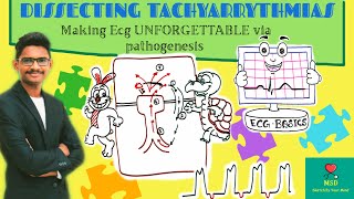 ECG Basics  Making Tachyarrhythmias Unforgettable Via Dissecting its Pathogenesis NEETPGINICET [upl. by Aidile]