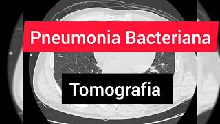 Pneumonia Bacteriana na Tomografia de Torax  TC [upl. by Aryam]