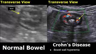 Small Bowel Ultrasound Normal Vs Abnormal Image Appearances  Gastrointestinal Tract GIT USG [upl. by Fevre]