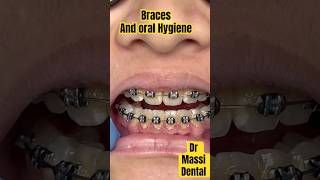 Dental Braces and oral Hygiene [upl. by Andreana]