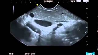 Endosonography in Autoimmune Pancreatitis [upl. by Ymor]