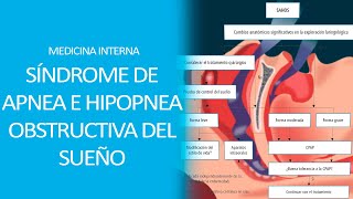 Medicina Interna  Síndrome de Apnea e hipopnea Obstructiva del Sueño SAHOS [upl. by Hilde]