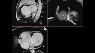 MRI Whole heart 3D sequence without contrast Siemens Egypt [upl. by Gerson]