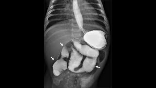 BARIUM MEAL procedure By ZAMZAM DIGITAL XRAY CENTER MIANWALI [upl. by Edwyna]