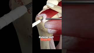 Rotator cuff tear repair surgery animation  Medical animation [upl. by Aikem154]