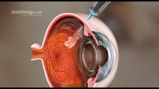 Intravitreal Injection Animation HD [upl. by Kwan963]