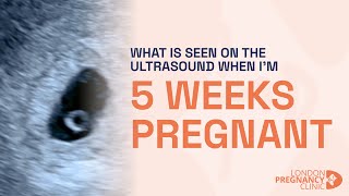 What would an ultrasound show at 5 weeks of pregnancy A London Pregnancy Clinic case study [upl. by Nuawad]