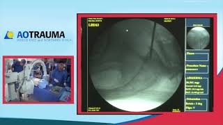 Percutaneous insertion of S1 iliosacral screw Mr Anthony Ward [upl. by Chandal]