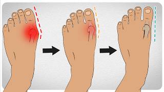 How to Fix Bunions in 5 Steps [upl. by Zetneuq]