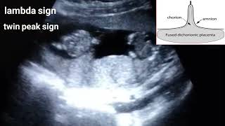 Dichorionic diamniotic twin pregnancylambda sign [upl. by Rox675]