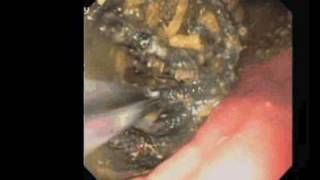 Removal of hairbands from a cat stomach [upl. by Karie]