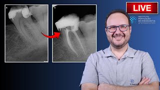 Endo Tx of 🦷37 with Irreversible Pulpitis amp Condensing Osteitis ▶️ Part 2  CASE164 [upl. by Aenert]