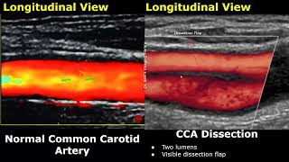 Carotid Artery ColorSpectral Doppler Ultrasound Normal Vs Abnormal Images  ICA Stenosis USG [upl. by Nyletac]