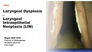 Laryngeal Intraepithelial NeoplasiaLIN Laryngeal Dysplasia [upl. by Nylhtac35]