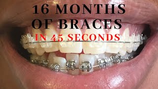 45 Second Full Braces Time Lapse [upl. by Awuhsoj]