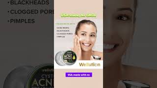 Wellution Cystic Acne Treatment face Cream howtolightendarkspots antiaging [upl. by Luhey790]