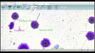 MMC Sperm DNA fragmentation analysis [upl. by Zerk903]