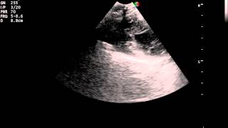 Right Parasternal Long Axis video Left ventricular outflow view 2 [upl. by Nakada]