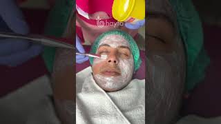 Pico Laser Treatment pemutih [upl. by Kcirrem412]